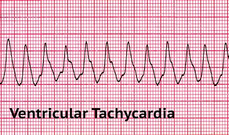 Pulseless Ventricular Tachycardia - The First Aid Show