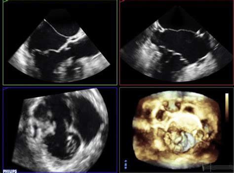 Multiplanar reconstruction of the mitral valve shows Barlow's pathology ...