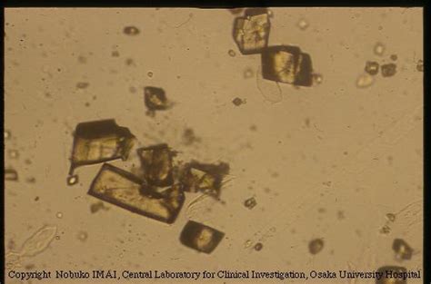 Sufla Crystals that resemble Uric Acid Crystals | Medical Laboratories