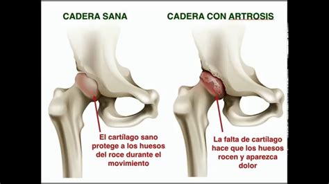 Artrosis de caderas: causas, consecuencias y recomendaciones. - Sociedad Colombiana De Apiterapia