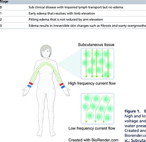 Clinical stages of lymphedema according to the International Society of ...