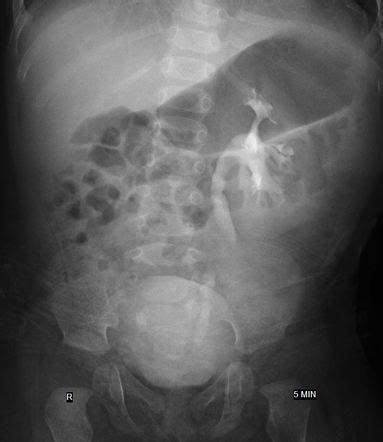 Renal agenesis | Image | Radiopaedia.org