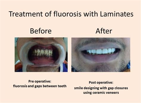 Treatment of Fluorosis with Laminates - SmileKonnekt