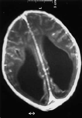 Axial T1-Gd-enhanced MRI shows the diffuse enhancement leptomeninges... | Download Scientific ...