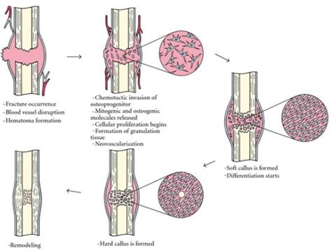 Briefly Describe the Process of Bone Remodeling - Roman-has-Levy