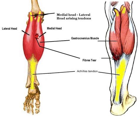 Medial gastrocnemius strain causes, symptoms, diagnosis, treatment & prognosis