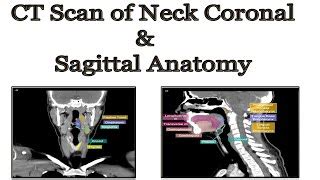 11+ Anatomy Nasopharynx Ct Pics