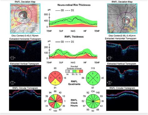 OCT RNFL at four-month follow up showed marked thinning of right RNFL. | Download Scientific Diagram