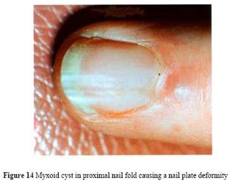 Nail Diseases: Longitudinal Grooves