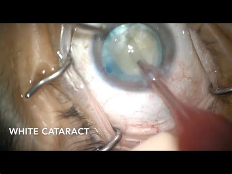 White Cataract Surgery- 17Sep2020 (#170) - YouTube