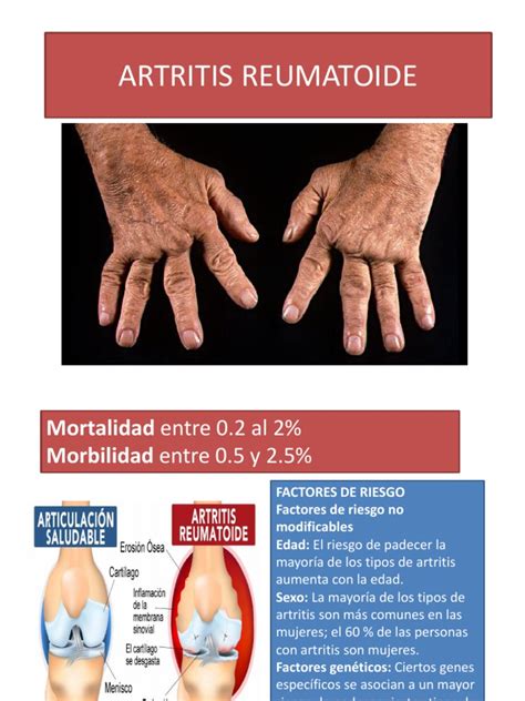 Artritis Reumatoide