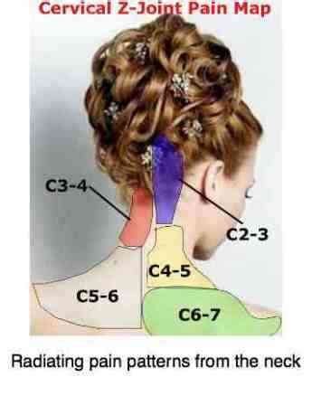 Cervical facet syndrome is a common sequela of MVAs and other whiplash