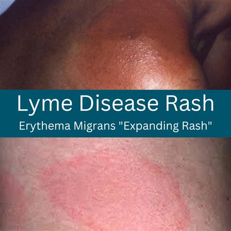 A Lyme rash doesn't always look like a bull's-eye target | LymeDisease.org