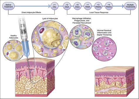 Fat Dissolving Injections - Dermacore