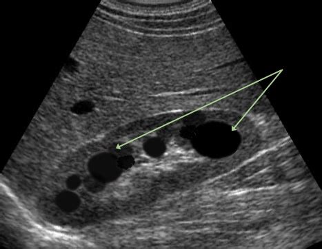 Renal Cyst Article