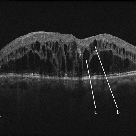 3 Intraretinal cystic lesions in OCT image caused by pseudophakic... | Download Scientific Diagram