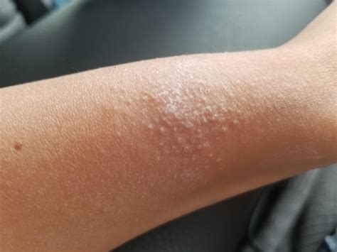 I have hundreds of itchy bumps all over my body,looks like flea bites ...