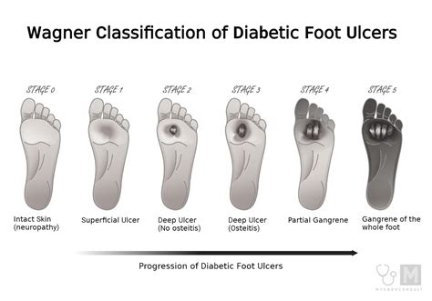 Diabetic Foot Ulcer Stages – A Concise Guide - My Endo Consult