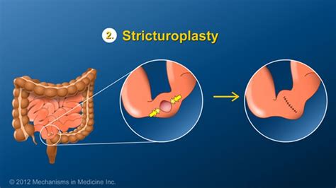 A stricturoplasty can relieve obstruction but does not remove any ...