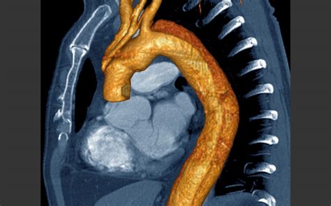 Aortic Dissection - A Needle in a Haystack - EMOttawa Blog