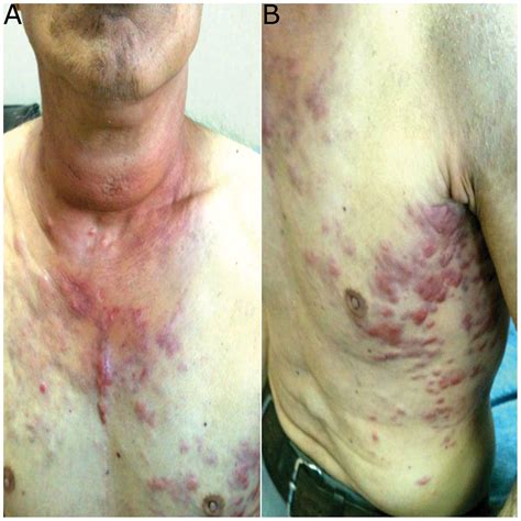 Anaplastic thyroid carcinoma with diffuse thoracic skin metastasis: A case report