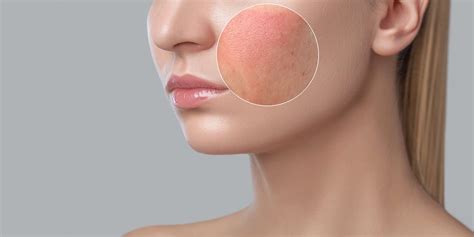 Facial Rash – 6 Common Causes, Symptoms and When to Seek Treatment – Dr. HM Liew Skin Clinic