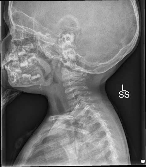 Epiglottitis and Croup - OpenAnesthesia