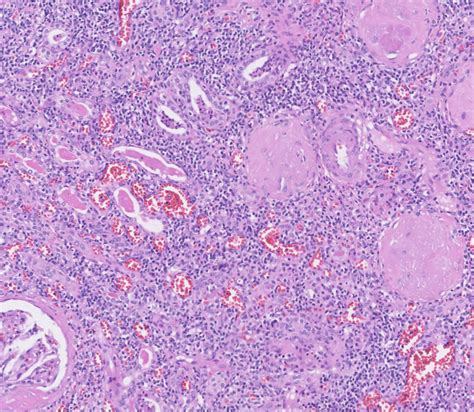 Chronic Pyelonephritis Histology