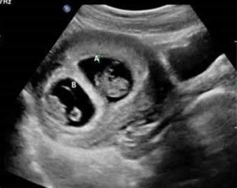 Twin pregnancy ultrasound. - Ultrasoundfeminsider