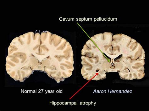 Aaron Hernandez Cte Brain Scan