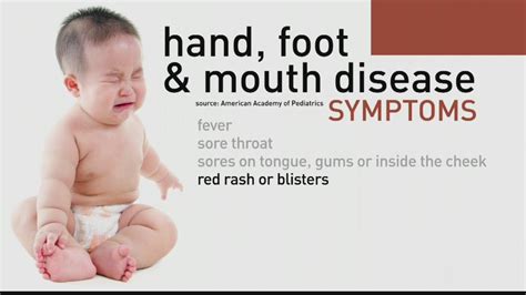 Hand Foot And Mouth Disease On Tongue