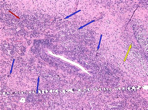 Clinical and Histological Features in Wegener Granulomatosis