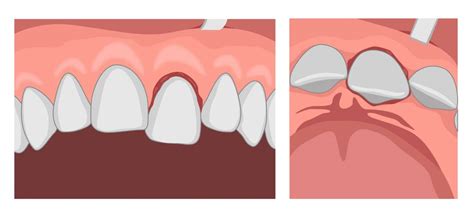 Dental Trauma | Geeky Medics