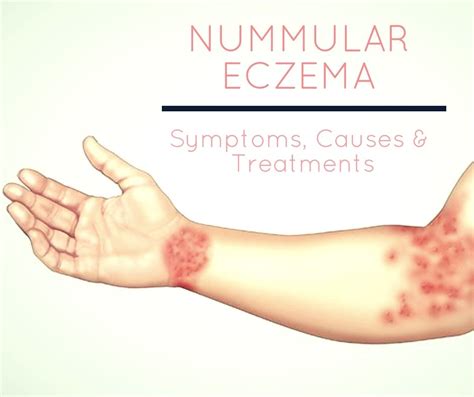 Nummular Dermatitis Eczema Diagnosis & Treatments | Nummular eczema ...