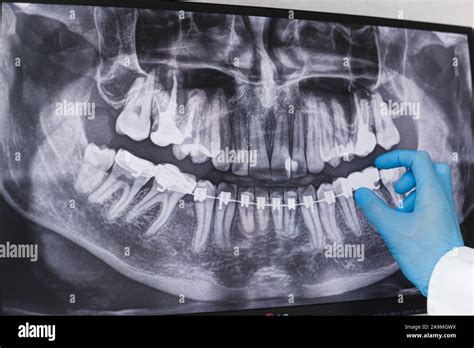 Doctor points to braces in dental x-ray Stock Photo - Alamy