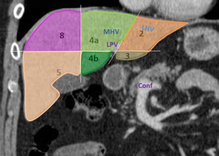 Liver Segmental Anatomy Ct Scan