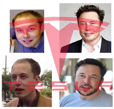 Elon Musk Hair Transplant History and Hair Analysis before and after