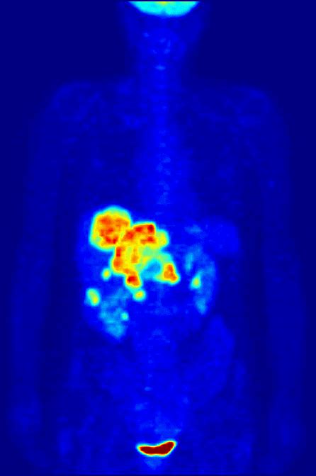 Nuclear Tomographic Imaging | Oncology Medical Physics