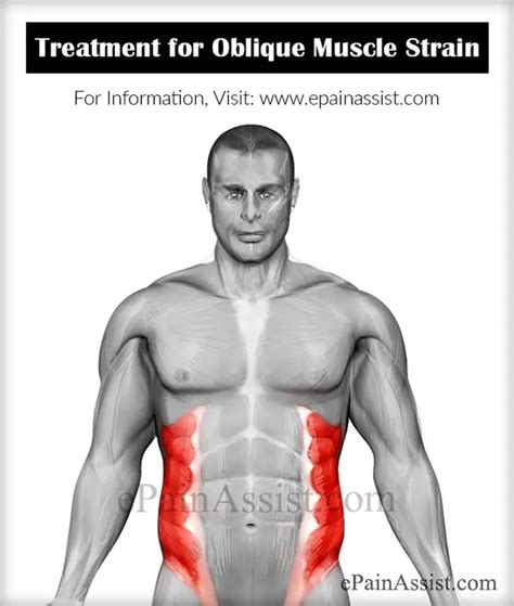 Oblique Muscle Strain|Causes|Symptoms|Treatment|Recovery