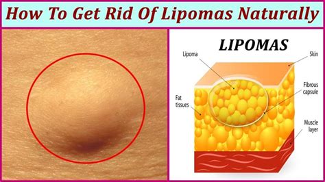 Lipomas, Fatty Tumors - NutriMedical