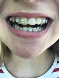 The Kerrie Show: 4 Issues Braces Can Help Fix