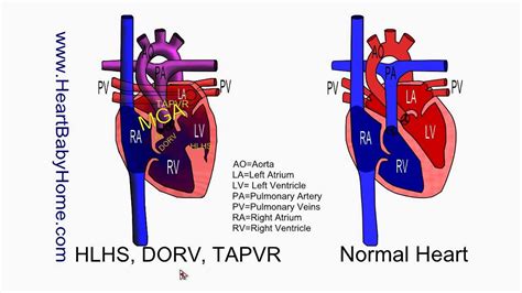 58 - HLHS, DORV, TAPVR with Glenn and Fontan - YouTube
