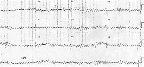 Ventricular Fibrillation (VF) • LITFL • ECG Library Diagnosis