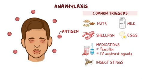 Anaphylaxis: Clinical sciences - Osmosis Video Library