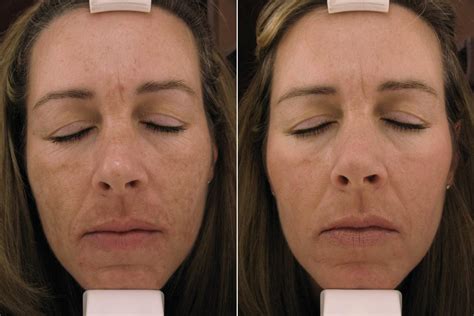 Melanage Peel in Philadelphia and Mainline PA - Ringpfeil Dermatology