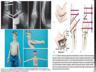 Supracondylar osteotomy for treatment of cubitus varus | PPT