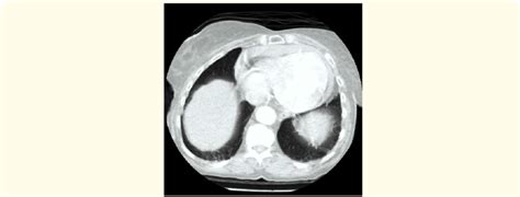 Hemopericardium (CT). | Download Scientific Diagram