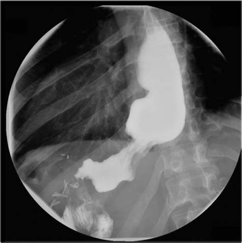 Upper GI series showing hold-up of contrast at the gastrojejunostomy ...