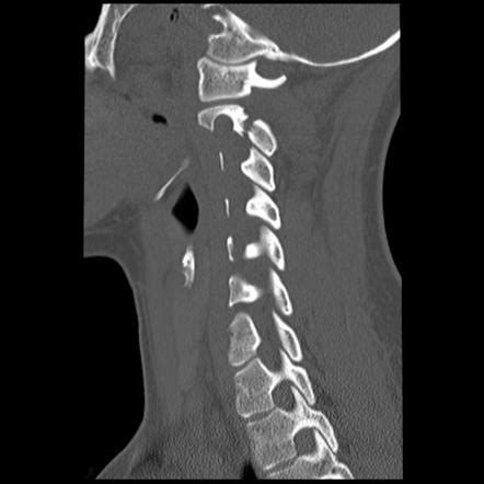 Hangman Fracture