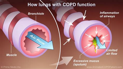 In COPD however, the airways become thick and inflamed and they produce more mucus than usual ...